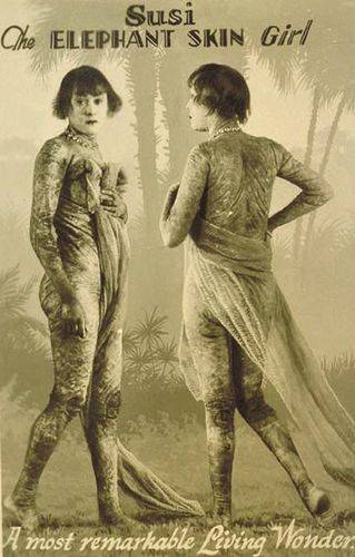 Сьюзи (1909-1975) — «девочка-крокодил». Ихтиоз придал её коже странную структуру и цвет; выступала она вплоть до 1967 года.