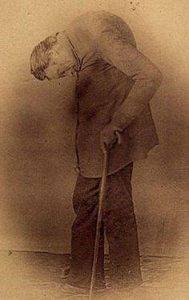Леонард Траск, «удивительный инвалид» (1805–после 1860) стал демонстрировать себя на старости лет, чтобы прокормиться.